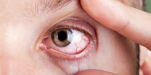 درمان خانگی خشکی چشم 
