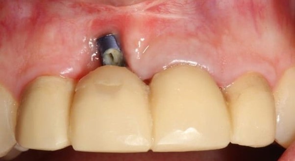 ایمپلنت های دندانی تیتانیومی