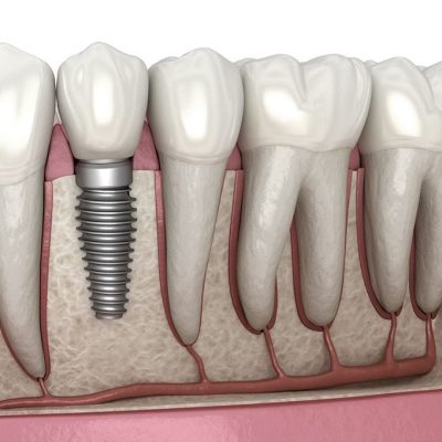 طول عمر ایمپلنت دندان و عوامل موثر بر آن
