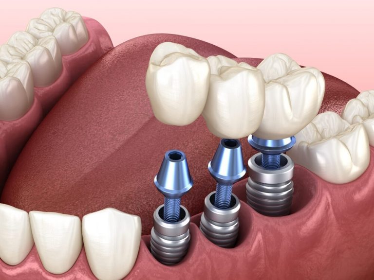طول عمر یا دوام ایمپلنت دندان