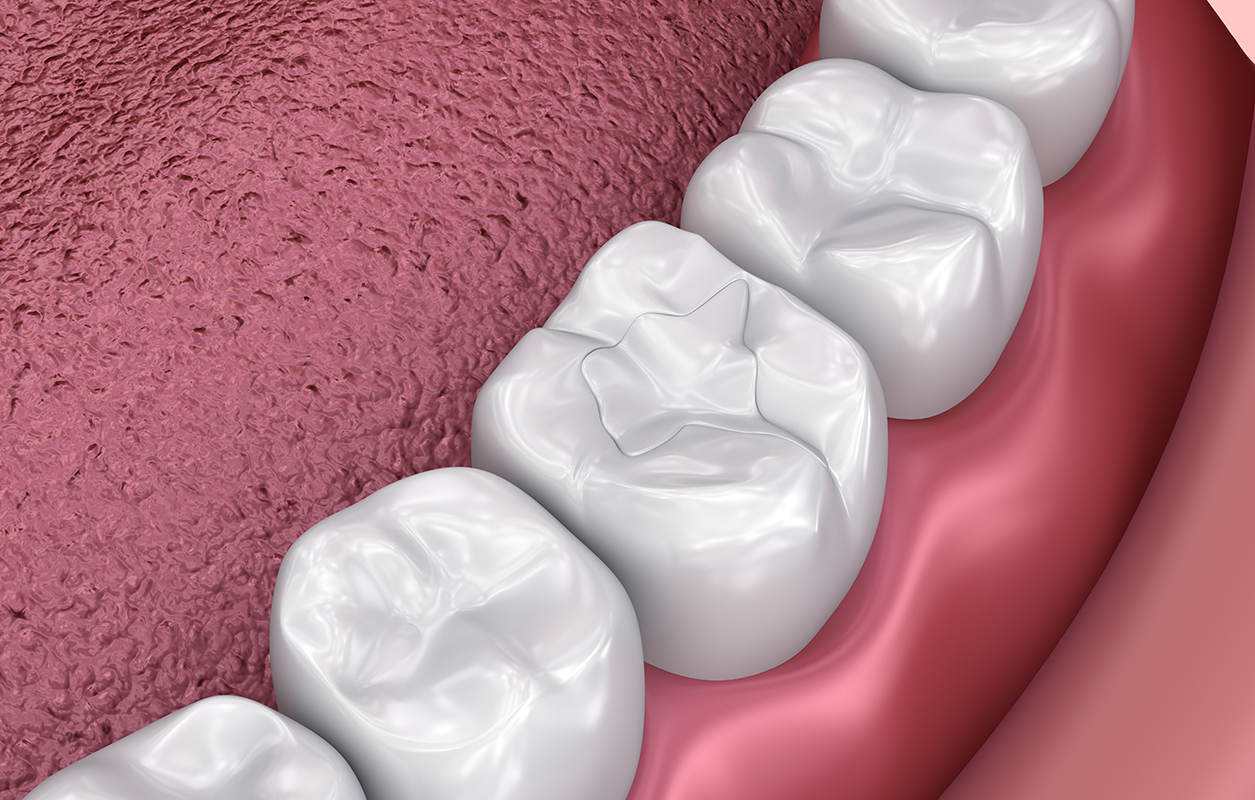 Fissure Dental Fillings, Medically Accurate 3D Illustration