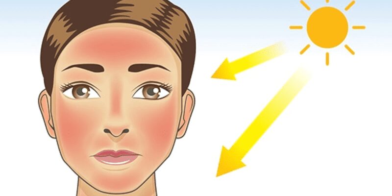 بهترین روش برای درمان آفتاب سوختگی