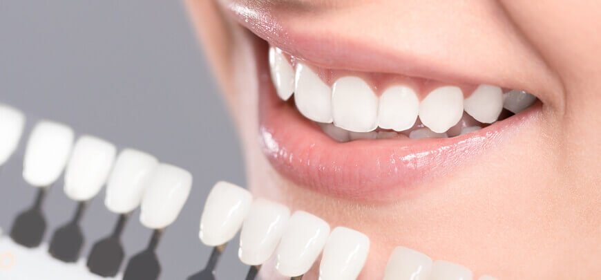 زیبایی دندان