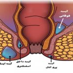 فواید فعالیت بدنی بر مدیریت وزن در میانسالی آبسه مقعدی و عوارض آن + درمان خانگی و جراحی
