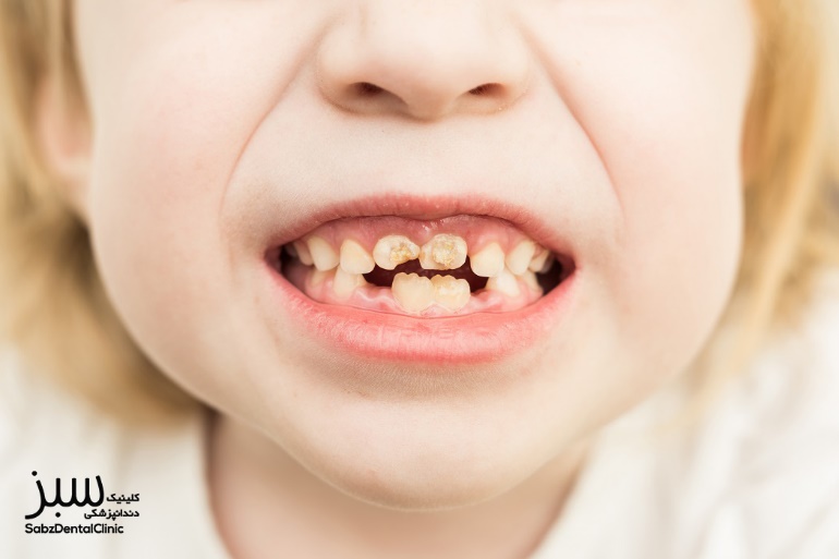 درمان دندان درد کودکان