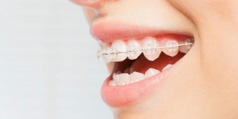 Colorless Orthodontics0000 1024X683 1