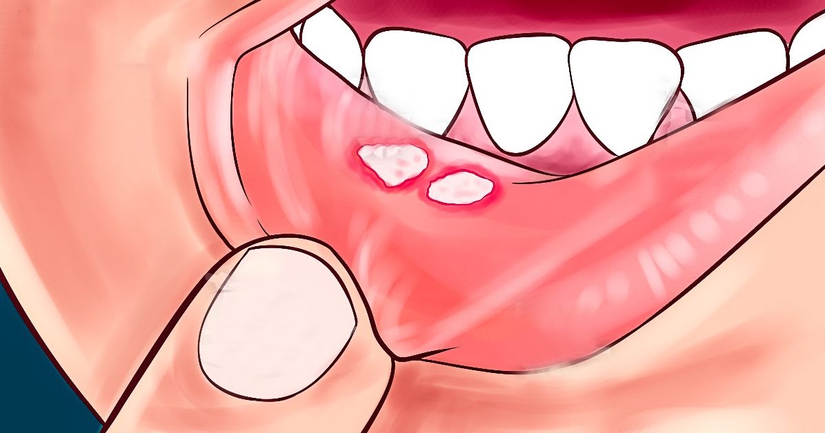 درمان قطعی آفت دهان تصویر 1 1