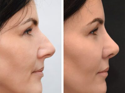های قبل و بعد از جراحی بینی تصویر 1